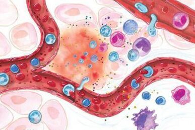 A Boswellia hatása a test gyulladt területeire