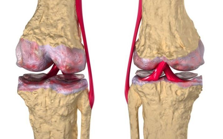 A térdízület osteoarthritis