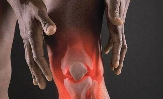 Az arthrosist gyulladásos folyamat kíséri a térdízületben